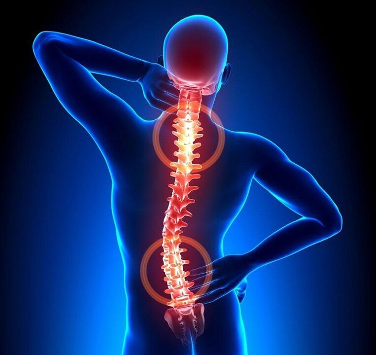 Ostéochondrose de la colonne vertébrale comme cause de maux de dos