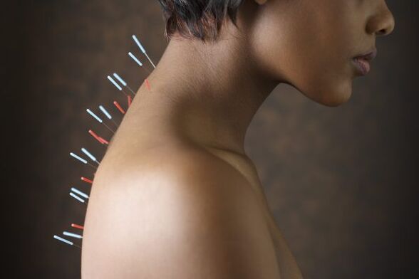 Acupuncture pour les maux de dos