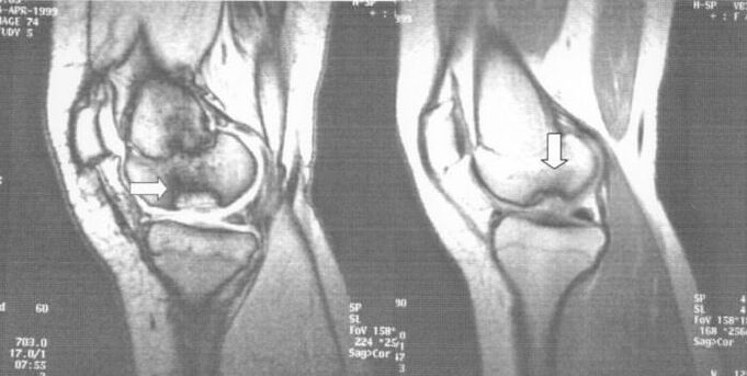 Radiographie de l'ostéochondrite disséquante dans l'articulation du genou