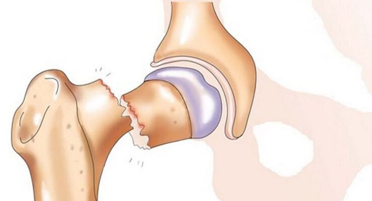 Une fracture du col fémoral est associée à une douleur intense au niveau de l'articulation de la hanche