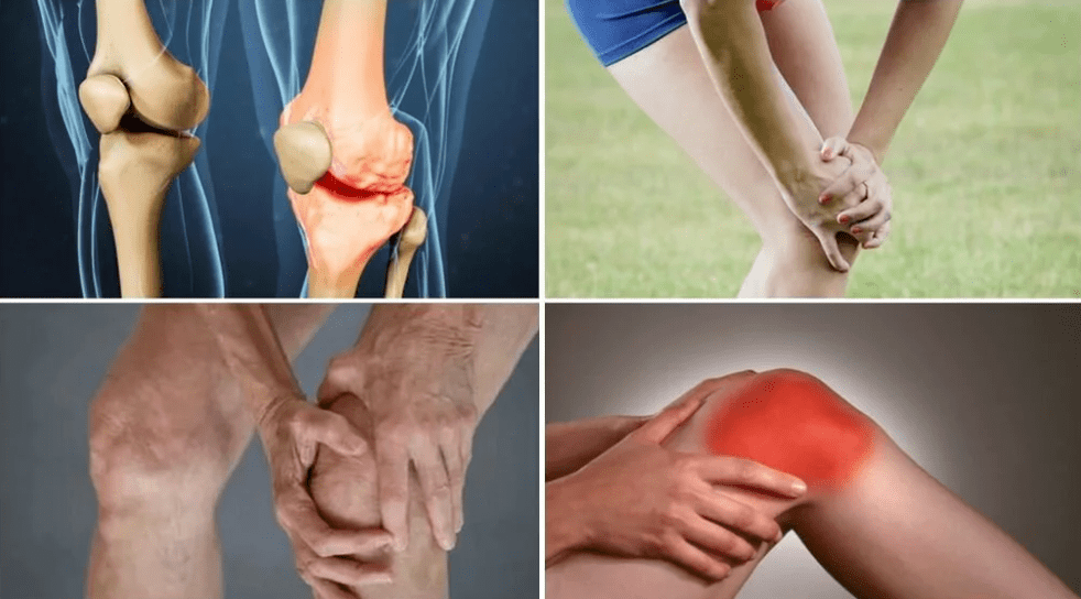 Symptômes d'arthrose