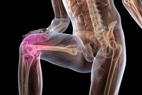 Douleurs articulaires dues à l'arthrose du genou