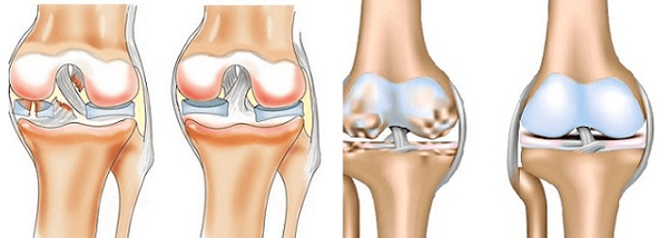 Arthrite et arthrose